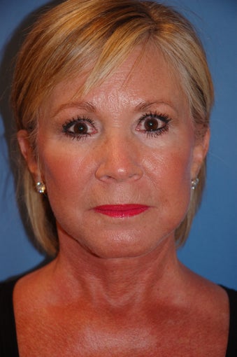 Facelift
