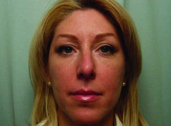 The Liquid Facelift