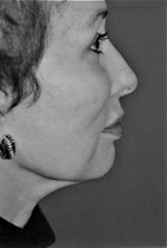 Facelift / Neck Lift