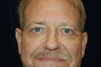 Face Lift and Lower Blepharoplasty