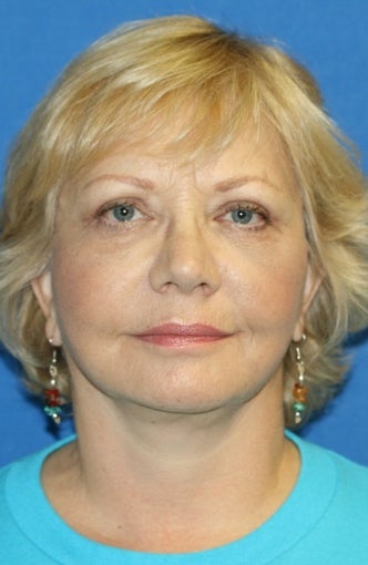 Face Lift