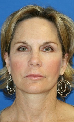 face Lift