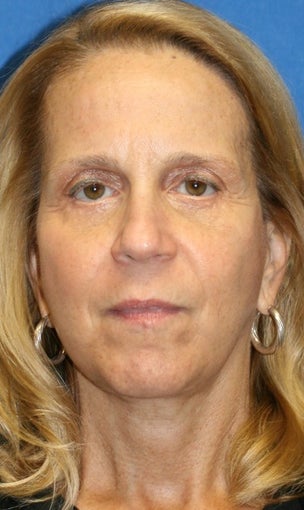 5 months post-op: Facelift, Necklift, Full Face Fat Transfer, and Lower Eyelid Skin Pinch