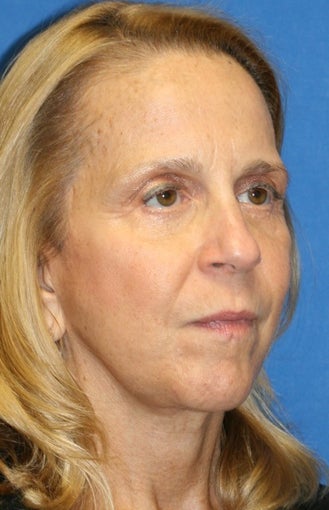 5 months post-op: Facelift, Necklift, Full Face Fat Transfer, and Lower Eyelid Skin Pinch