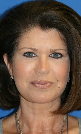 Facelift