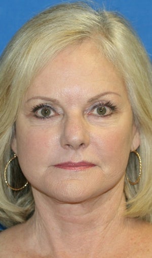 Short Incision Facelift and Lateral Browlift
