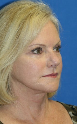 Short Incision Facelift and Lateral Browlift
