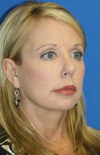 Facelift, Necklift, Fat Transfer, Upper Bleph., Lower Eyelid Skin Pinch