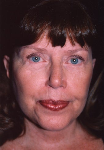 Facelift and blepharoplasty