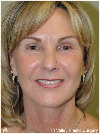 Facelift