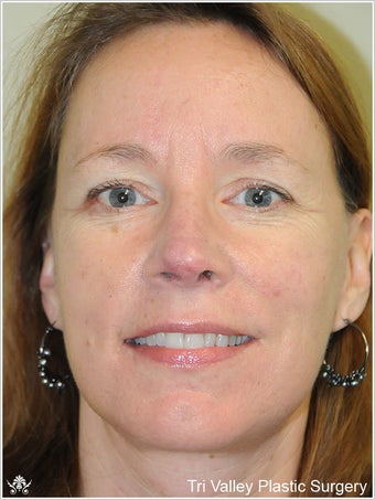 Facelift