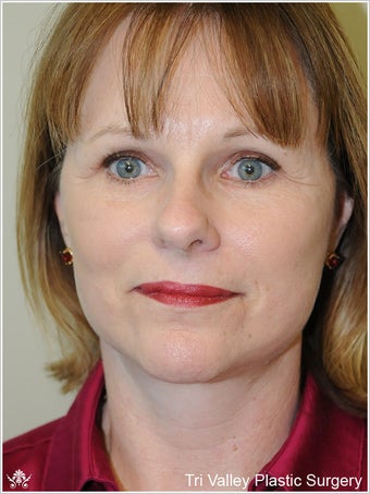 Facelift