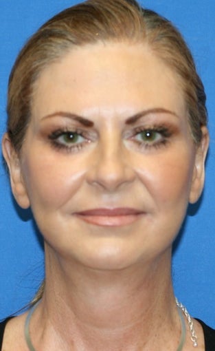 Facelift, Fat Transfer, Upper Bleph, Lower Eyelid Skin Pinch