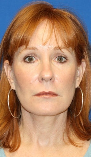 2 years post op: Facelift, Lower Eyelid Skin Pinch, and Peri-orbital Fat Transfer