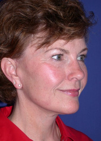 Facelift