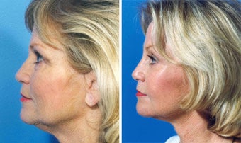 Facelift
