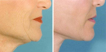 Facelift