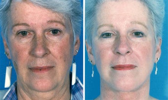Facelift