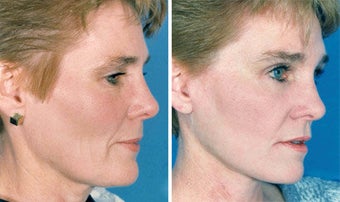 Facelift