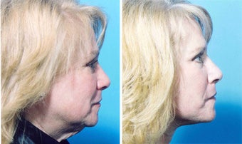Facelift