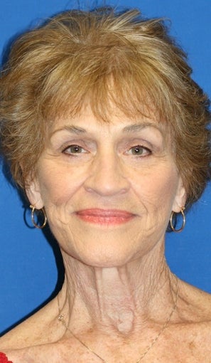Facelift, Browlift, & Skin Pinch