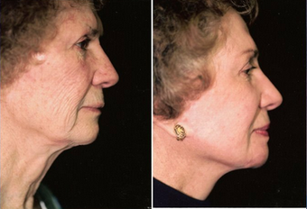 Facelift, lipo under chin, lower eyelids, endo forehead lift, laser