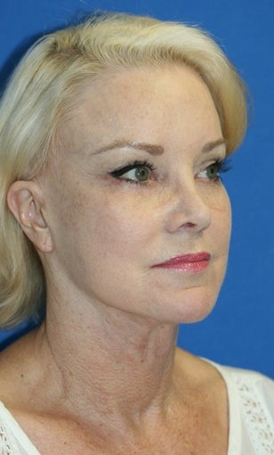 Facelift with Extended Necklift, Browlift, Peri-orbital Fat Transfer, and Skin Pinch