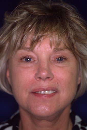 Facelift