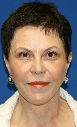 Facelift with Extended Necklift, Browlift, Fat Transfer, Upper Blepharoplasty, and Skin Pinch