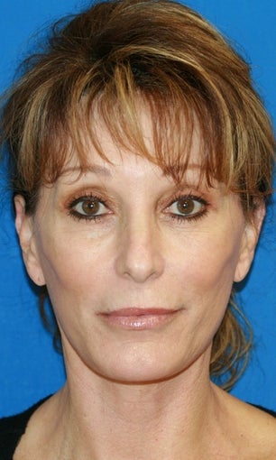 Facelift with Extended Necklift and Upper Blepharoplasty