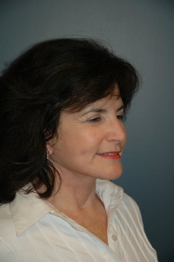 Cheek and Neck Lift