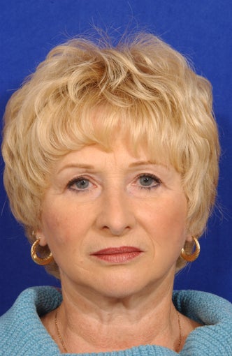 Face-necklift, Superficial cheeklift, upper blepharoplasty