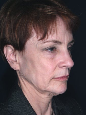 Vertical Facelift 