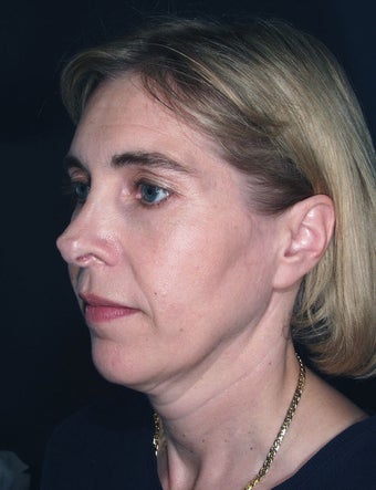 Laser used for cutting - Vertical Facelift