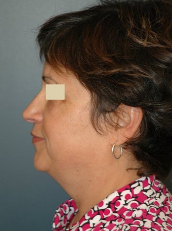 Facelift