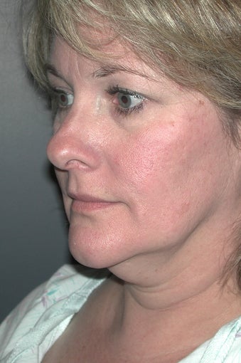 Facelift