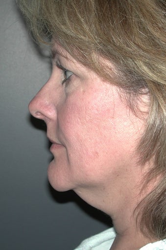 Facelift