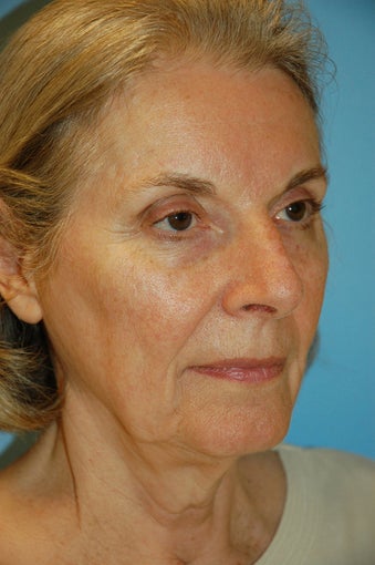 Facelift