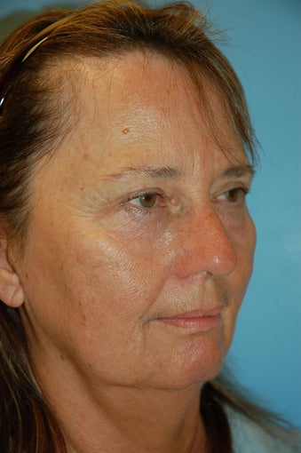 Facelift, Upper and Lower Blepharoplasty and Chin Implant