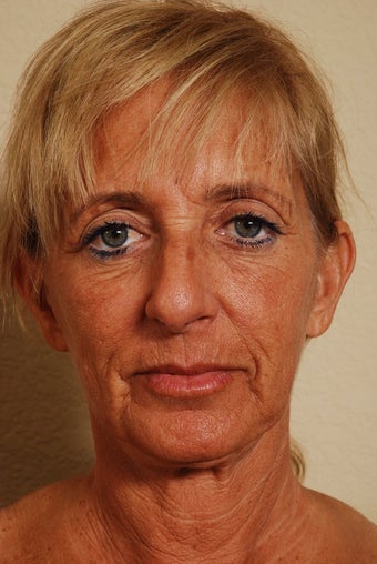 Stem Cell Enriched Facial Rejuvenation