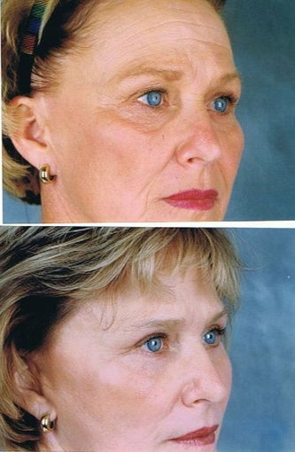 Revision facelift