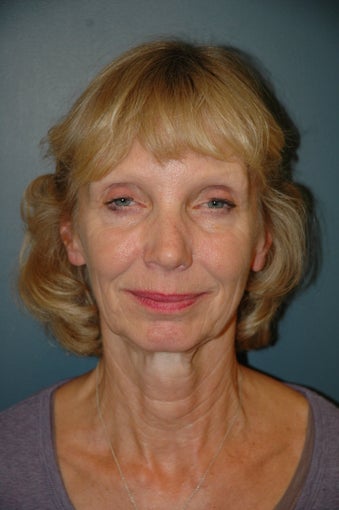 Facelift