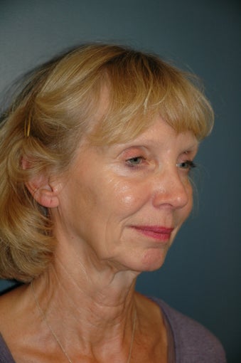 Facelift