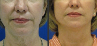 Facelift