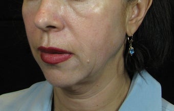 Facelift