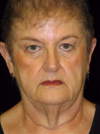 Complete faclift