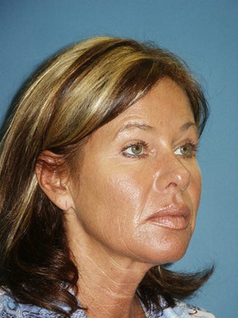 Facelift, Endoscopic Browlift, Upper and Lower Blepharoplasty