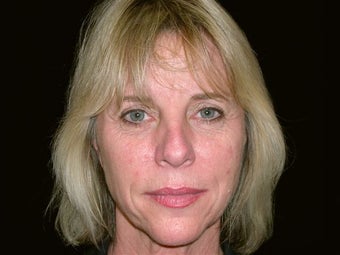 Full face , brow and eyelid lift,nose re-shaping,fat inj-face chin implant,lip agmentation,Tca chemical peel