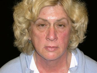 Face lift,brow lift, eyelid lift, fat injections face-volume replacement