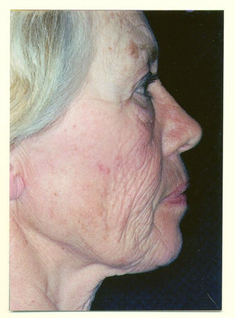 Facelift